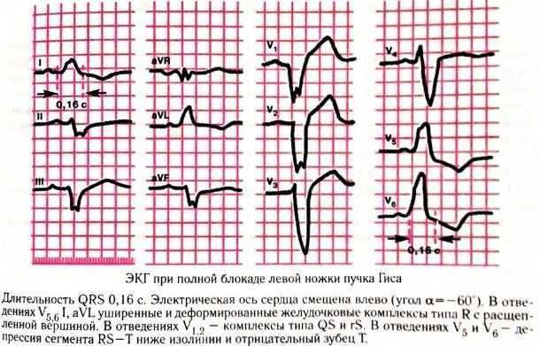 Блокада левой ножки пучка Гиса на ЭКГ (полная и неполная)
