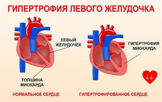 Утолщение стенок сердца - Все про гипертонию