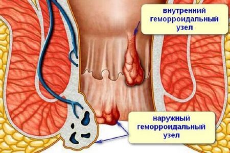 Вылез геморроидальный узел