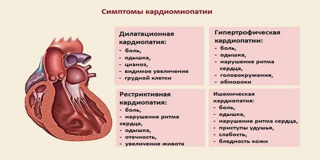 Гипертрофическая кардиомиопатия.