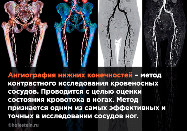 Ангиография сосудов нижних конечностей (КТ, МР, МСКТ): как проводится и что показывает