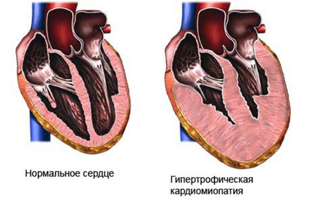 Сердце расширено влево — Сердце