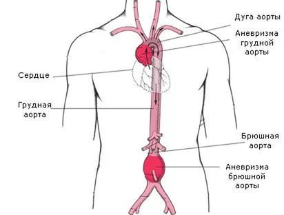 Атеросклероз брюшной аорты