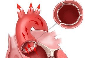 Уплотнение аорты – причины, симптомы, осложнения и лечение уплотнения аорты