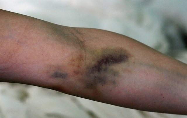 Флебит вены на руке. Лечение постинъекционного флебита после катетера