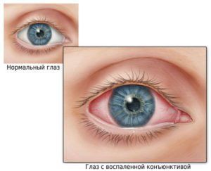 АКТОВЕГИН (ГЕЛЬ) - инструкция по применению, цена, отзывы и аналоги