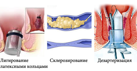 Удаление геморроя – современные операции