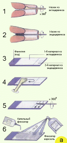 Онкоцитология шейки матки - мазок на онкоцитологию. Цитограмма воспаления с расшифровкой