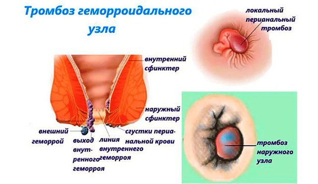 Геморрой при беременности - чем и как лечить геморрой беременной?