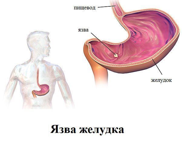 Спеман и его аналоги: Трибестан, Спематон, Спермактин и Спеман форте для мужчин
