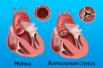 Аортальный порок сердца: симптомы и лечение