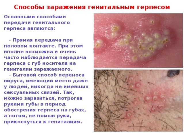 Генитальный герпес - фото проявлений у мужчин и женщин