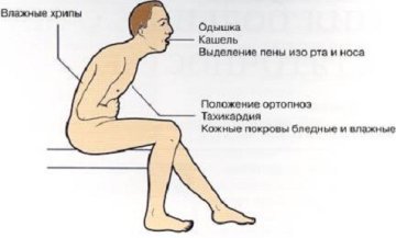 Кардиогенный отек легких - причины, симптомы, диагностика и лечение