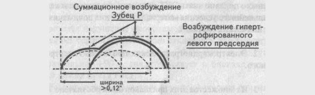 Гипертрофия правого предсердия на ЭКГ: симптомы перегрузки сердца