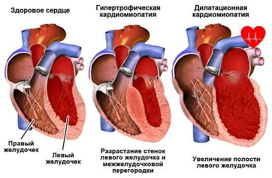 Утолщение стенок сердца - Все про гипертонию