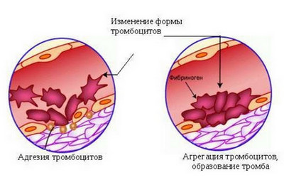 Агрегация тромбоцитов с АДФ, адреналином, ристомицином, коллагеном – норма. Что такое агрегация, гиперагрегация, гипоагрегация тромбоцитов?