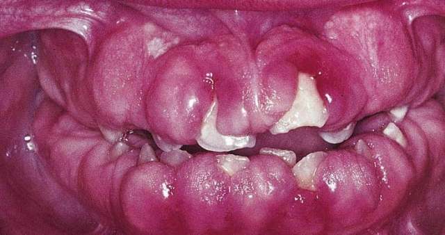 Гипертрофический гингивит