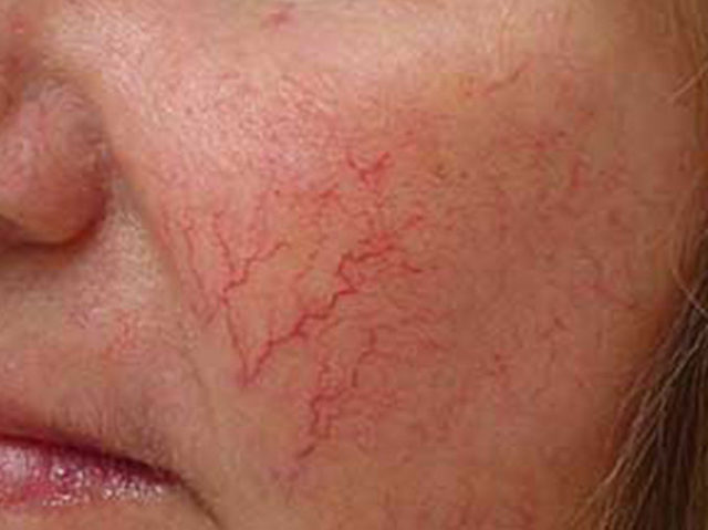 Как убрать красные сосуды на лице в домашних условиях