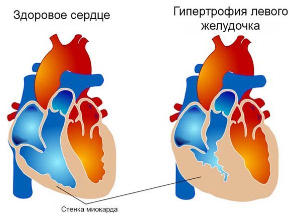 Физ упражнения при брадикардии - Про гипертонию