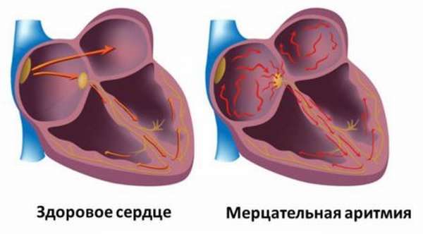 Предсердный ритм норма или патология?