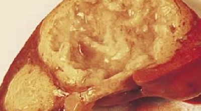 Абсцесс печени: диагностика, симптомы и лечение