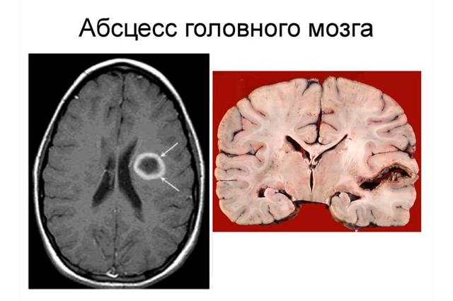Абсцесс головного мозга - симптомы, лечение, причины, прогноз