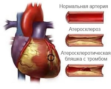 Как жить после стентирования сердца - осложения, диета, реабилитация, лекарства