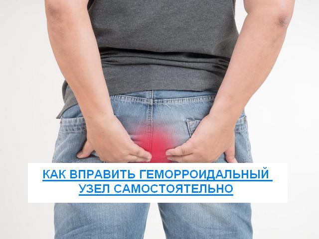 Как вправить геморроидальный узел самостоятельно пошаговая инструкция