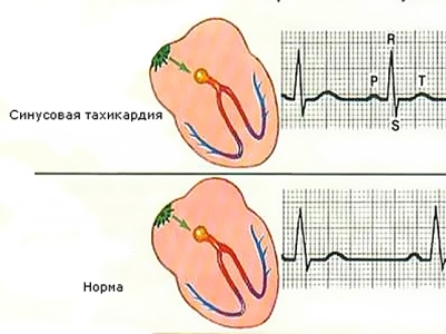 Синусовый ритм: что это в заключении ЭКГ, расшифровка и норма