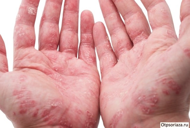 Лечение псориаз на руках - фото, симптомы, виды псориаза на руках