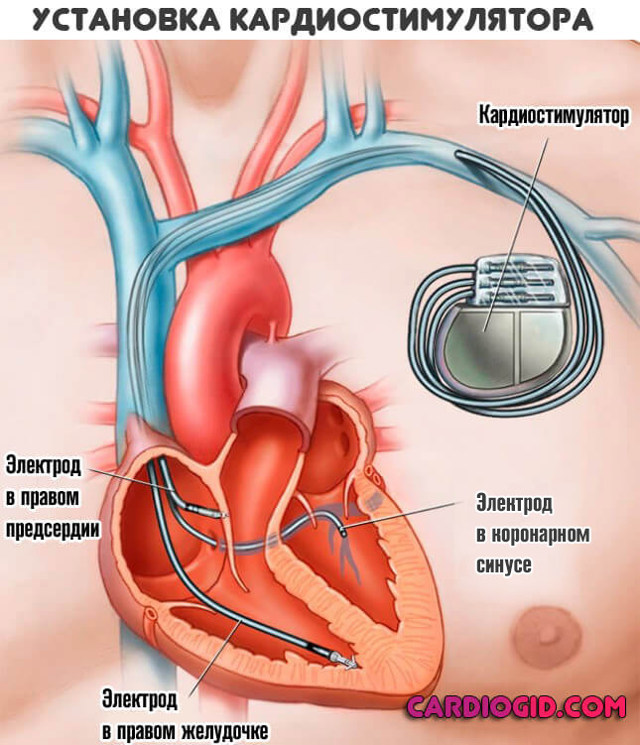 Высокое давление тахикардия - Лечение гипертонии