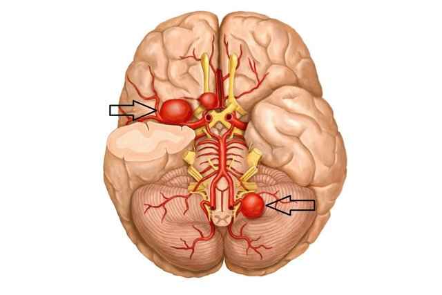 Ангиография (МРА) головного мозга. Личный опыт