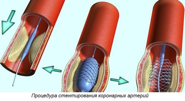 Инвалидность при инфаркте миокарда