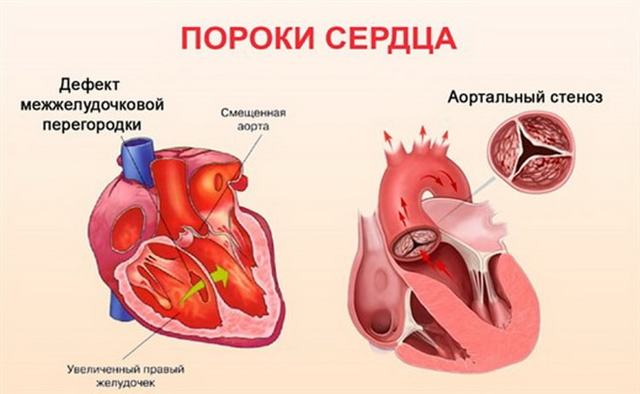 Шумы в сердце у новорожденного ребенка, грудничка: причины