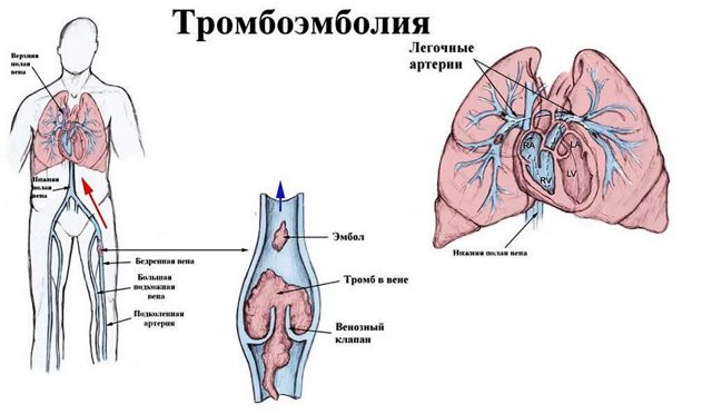 Тромбоэмболия - что это такое: признаки, диагностика и профилактика