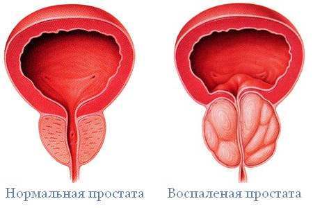 Боль, жжение и рези при мочеиспускании у женщин и мужчин: причины и лечение