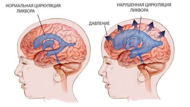 Что такое внутричерепная гипертензия и как её лечить