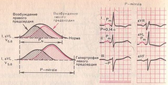 ЭКГ. Гипертрофия правого желудочка. Характерные признаки гипертрофии правого желудочка на ЭКГ