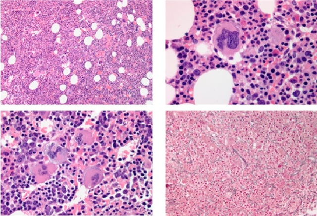 Что такое Полицитемия?