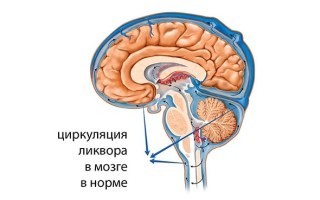 Как понизить внутричерепное давление быстро и просто?
