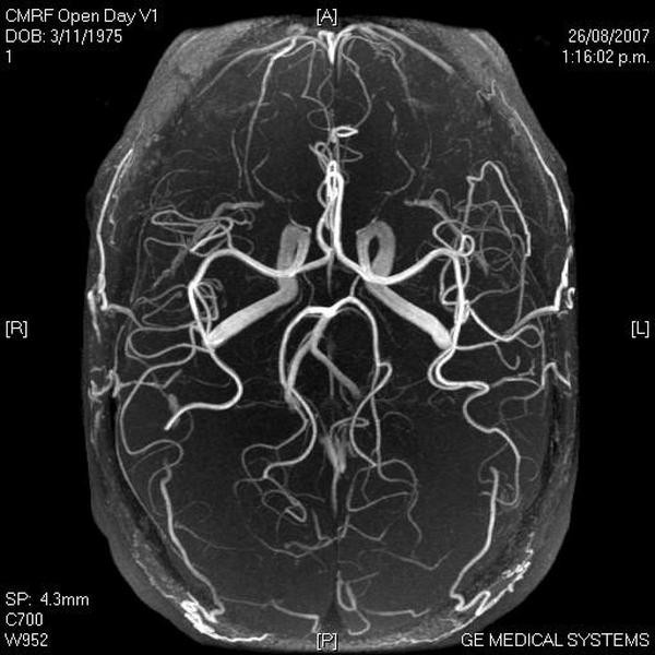 Гипоплазия правой позвоночной артерии