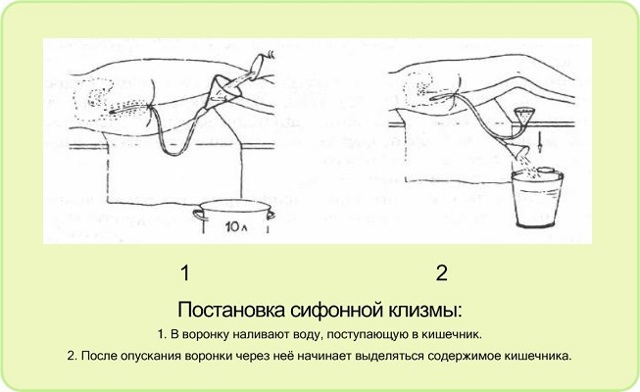 Виды клизм: различия, постановка, предосторожности