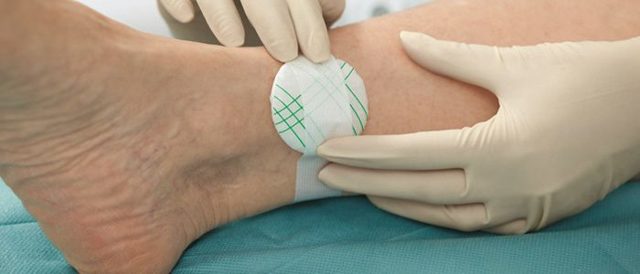 Трофическая язва - причины, симптомы, лечение, профилактика