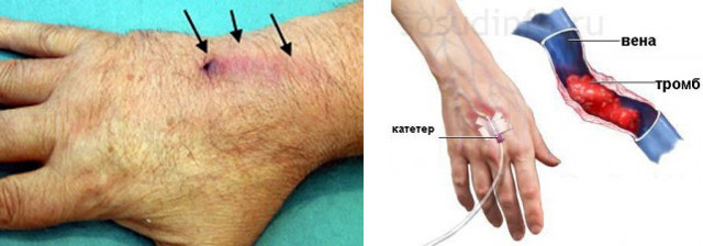 Почему видны вены на руках и как их убрать?