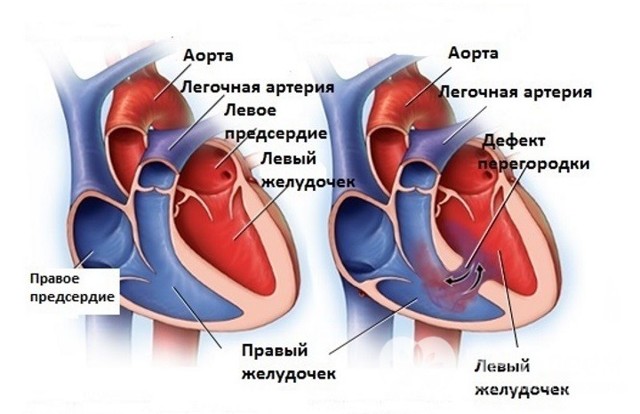 Дефект межпредсердной перегородки (ДМПП): причины, симптомы и особенности лечения