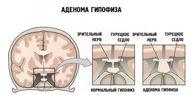 Высокое нижнее давление: причины и лечение