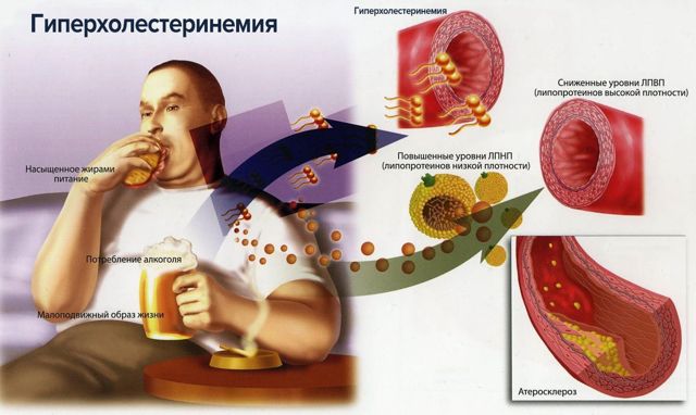 В сосудах бляшки: диагностика и терапия