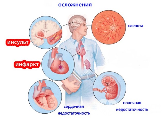 Гипертоническая болезнь — Викиучебник