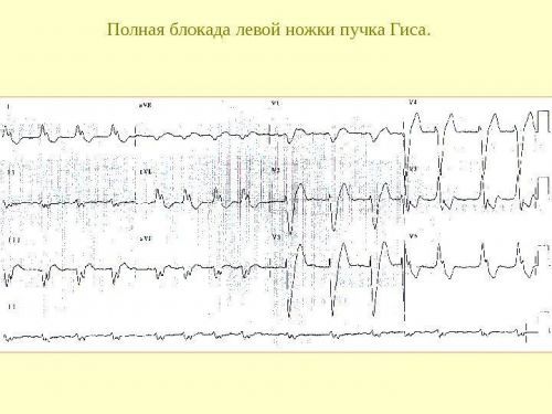 Блокада левой ножки пучка Гиса на ЭКГ (полная и неполная)