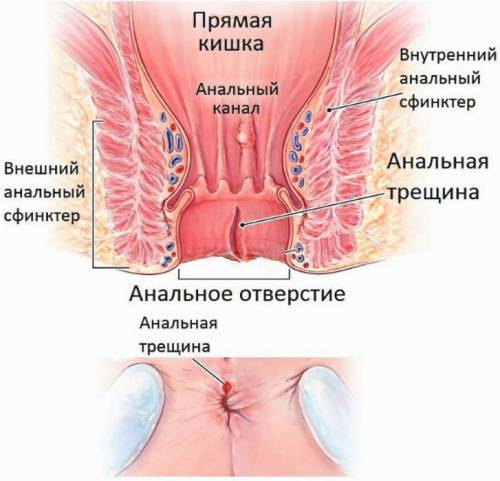 Свечи от геморроя и трещин прямой кишки